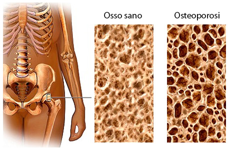 osteoporosi1