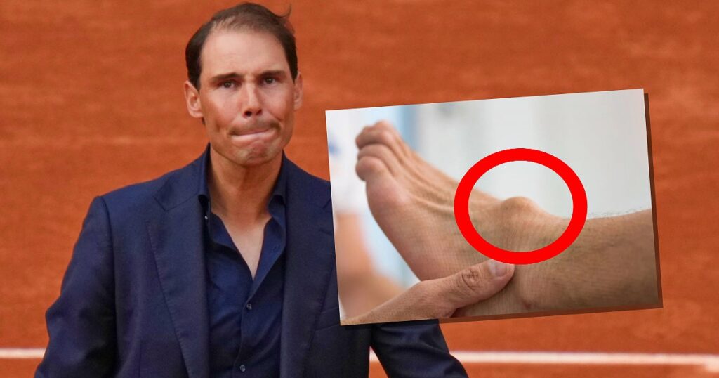 Rafael Nadal, il re indiscusso della terra battuta, ha svelato al grande pubblico il dramma silenzioso che ha tormentato la sua carriera: la sindrome di Müller-Weiss